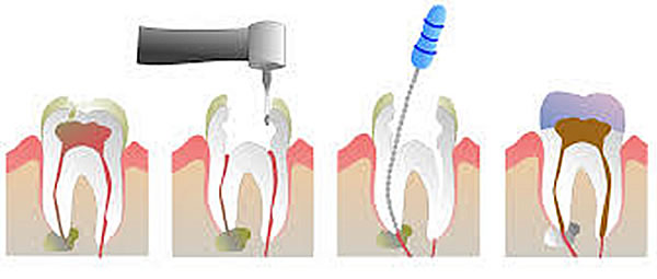 Root Canal Treatment