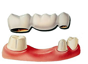 Bridges and Partial Dentures