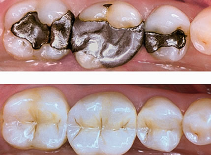 White fillings