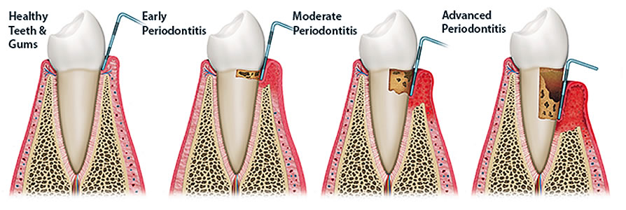 Gum disease