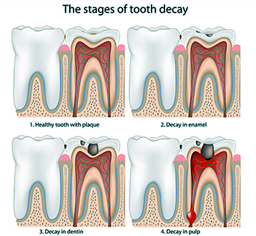 Dental Decay