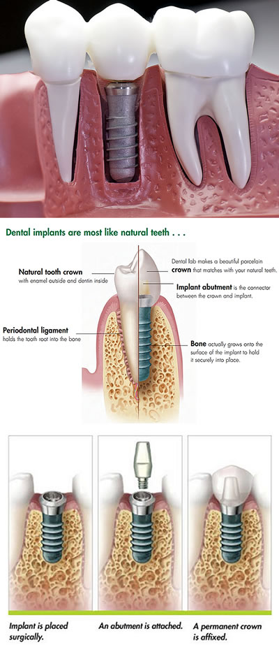 Implants referrals